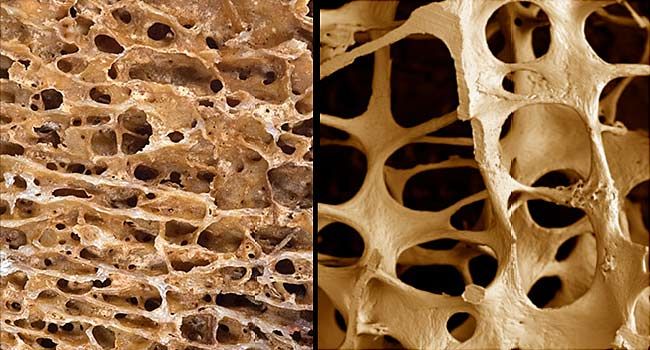 FDA Approves New Osteoporosis Treatment