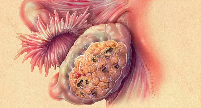 diagram of ovarian cancer