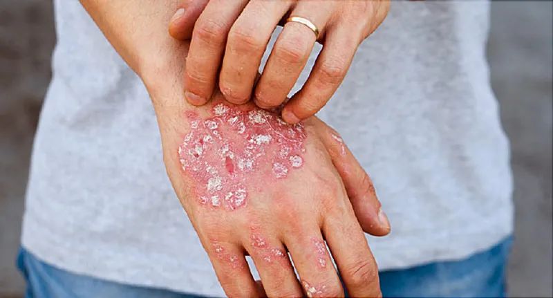 person scratching eczema