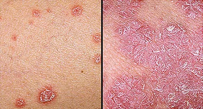 psoriasis white patches)