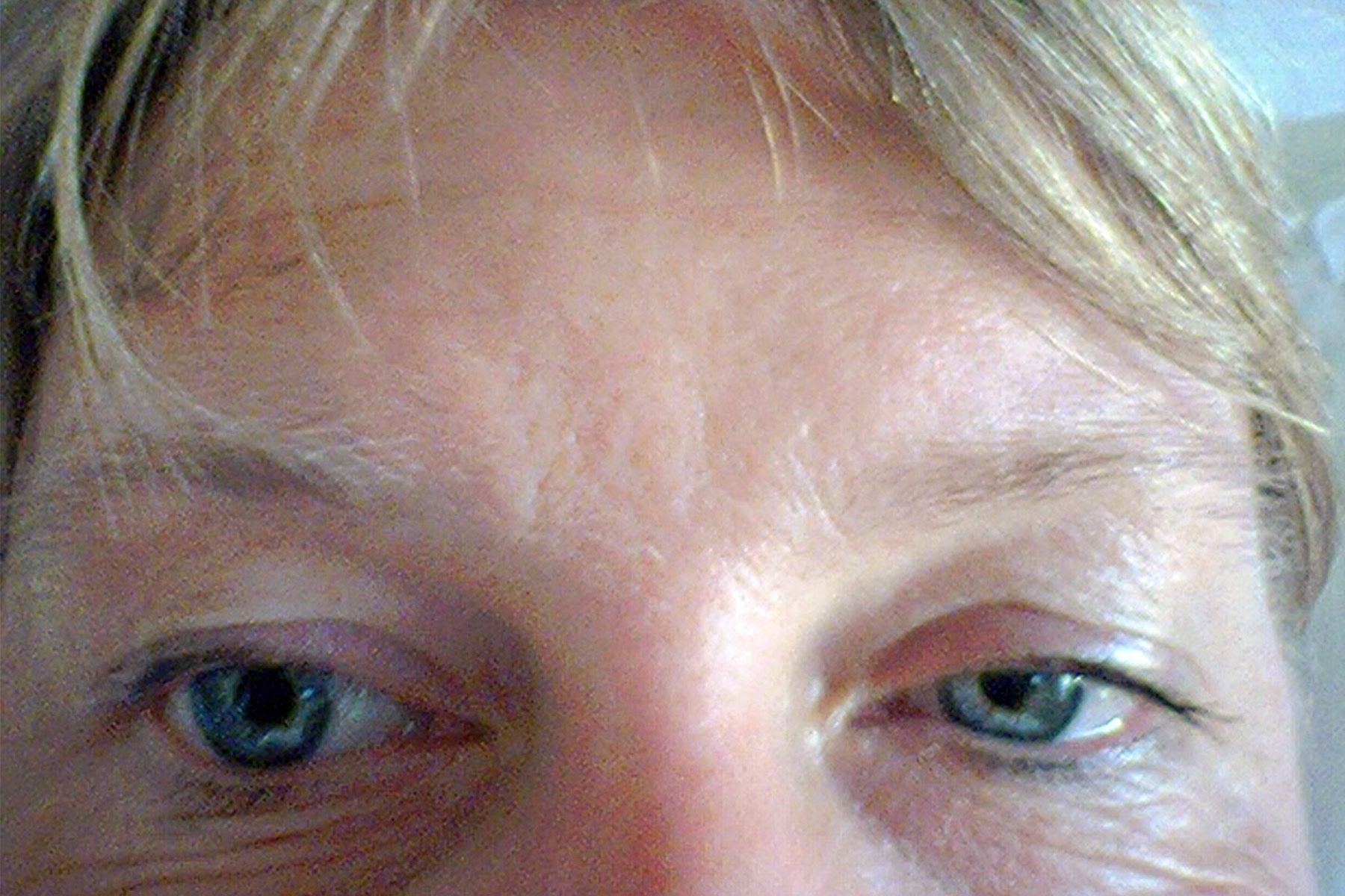 saggy eyelids