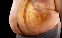 Cancer risk abdominal fat