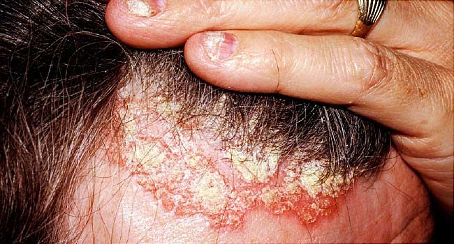 psoriasis flakes scalp pikkelysömör a fején henna kezelés