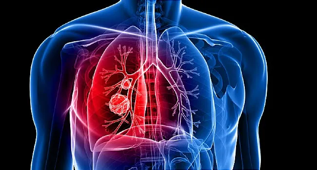 Signs of lung cancer in women