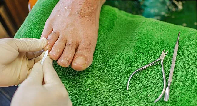 Toenail Fungus Pictures Of What It Looks Like Treatment Tips
