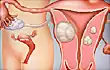 uterine fibroid illustration