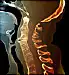 anklyosing spondylitis fused vertebrae