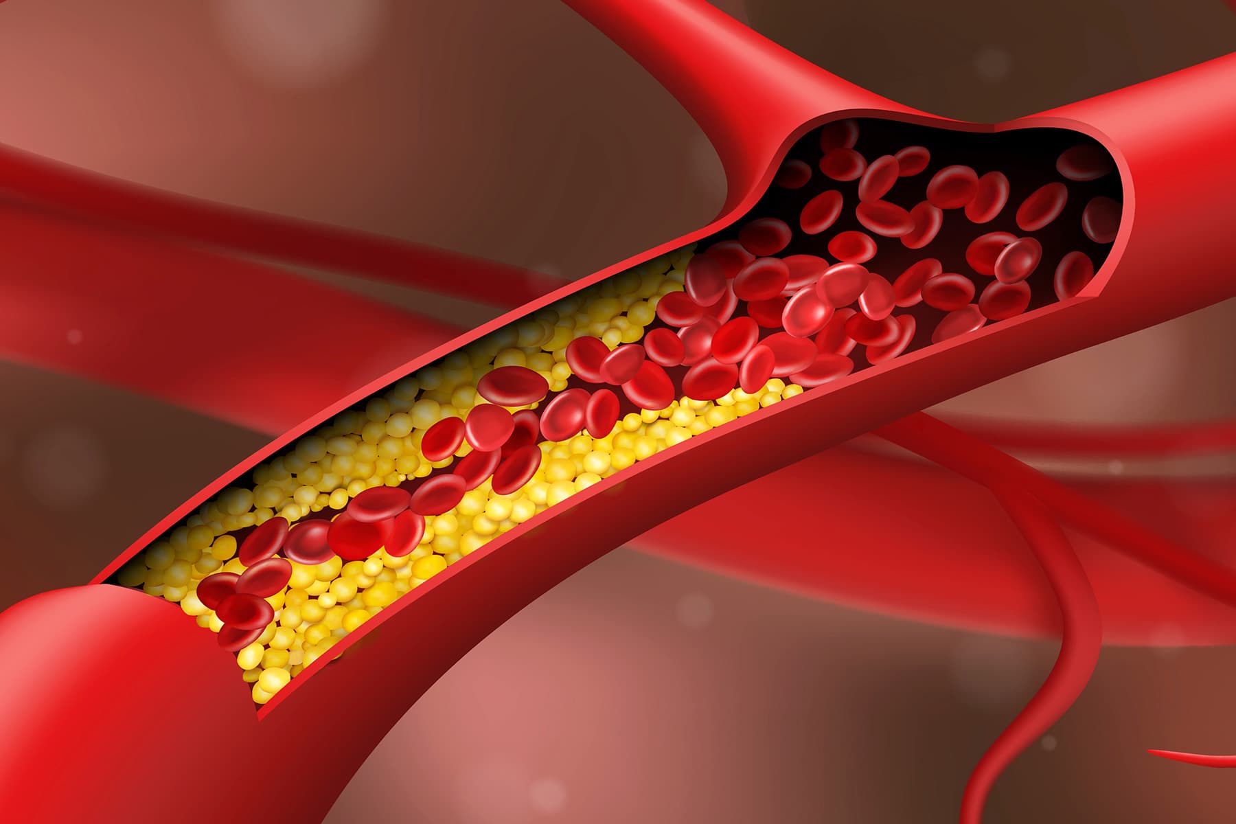 Clogged Arteries (Arterial Plaque) - Causes, Dangers, Tests ...