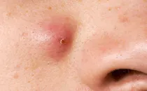 Cysts On Skin Pictures Of What They Look Like