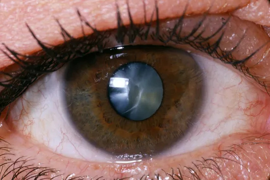 cataract close up