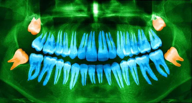 Pulling Wisdom Teeth Has Surprising Benefit: Better Taste