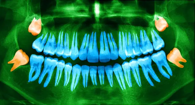 mouth xray highlighting wisdom teeth