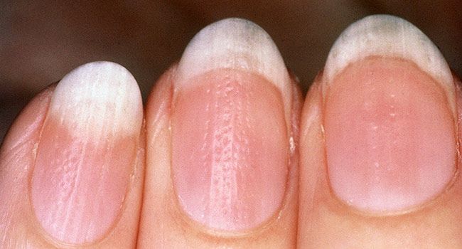What Your Fingernails Say About Your Health: Ridges, Spots ...