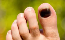 Pictures Of Toenail Colors And What They Mean