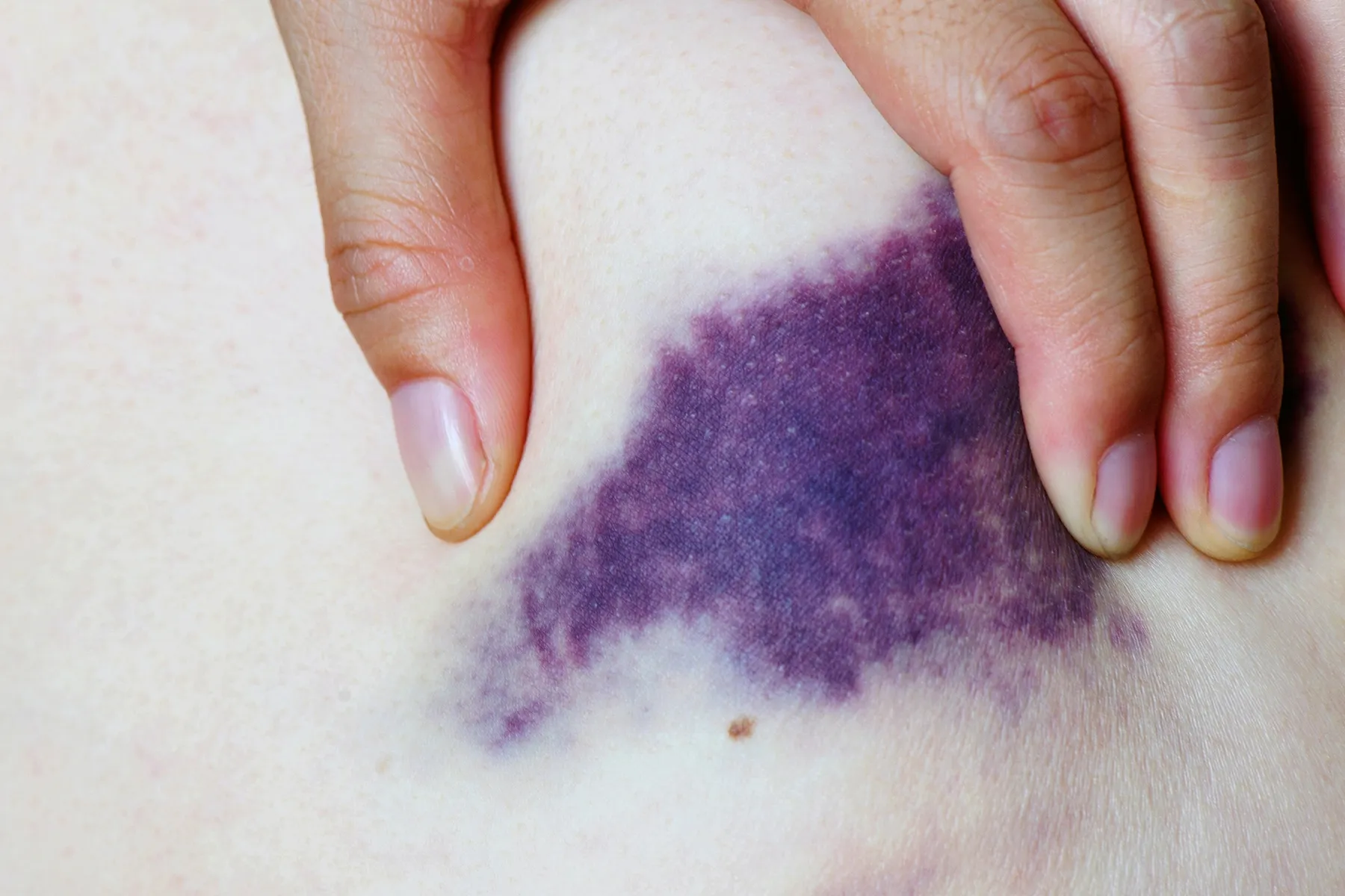 Why Do I Bruise Easily? Reasons It Happen