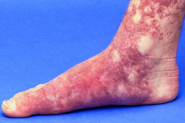 photo of Vascular malformations on foot