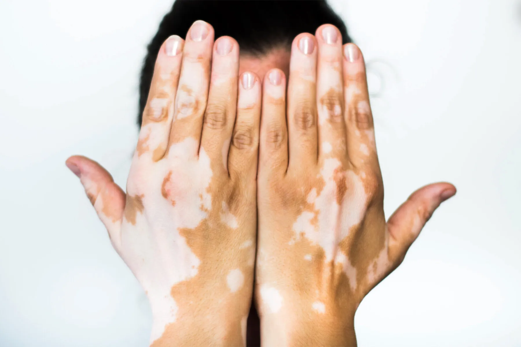 photo of vitiligo on hands