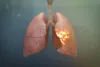 photo of lungs with pneumonia