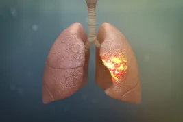 photo of lungs with pneumonia