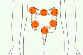 animated explainer ibd complications video