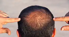 Styling Thinning Hair