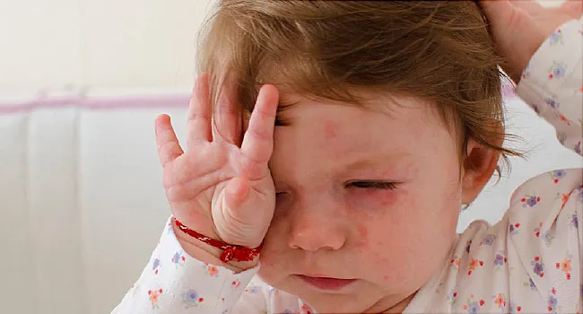 Roseola: Facts and Symptoms 2