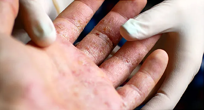 how to treat psoriasis on hands)
