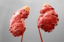 photo of med animation kidney disease inside look
