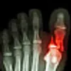 x-ray of broken toe