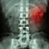 x-ray of kidney stones