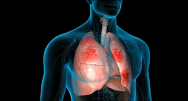 illustration of pneumonia
