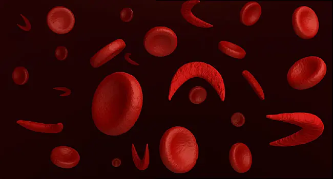 illustration of sickle cells