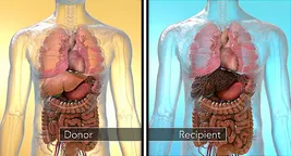 liver transplant illustration