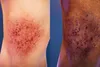 atopic dermatitis comparison skin of color
