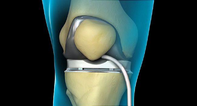 knee replacement animation