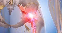 sciatica pain illustration