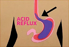 How to avoid acid reflux while sleeping