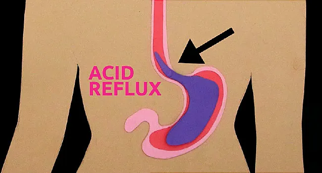 Heartburn Video on the Truth About Acid Reflux