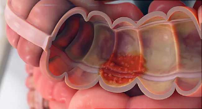 illustration of colon with ulcerative colitis