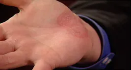 hand with psoriasis