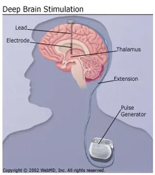 BrainStimulation