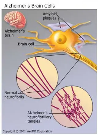 Alzheimers-Brain-Cells