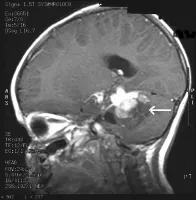 Brain Cancer MRI