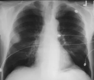 Bronchial Adenoma X-ray
