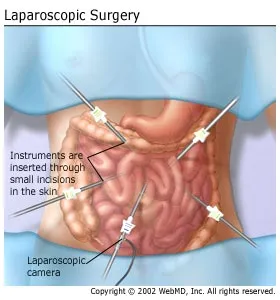cancer colon laparoscopia