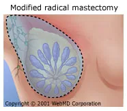 Modified Radical Masectomy