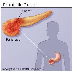 pancreatic cancer yesterday today and tomorrow)