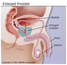 what size of prostate is dangerous Alfa prosztatitis