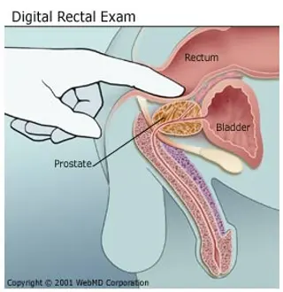 Digital Rectal Exams