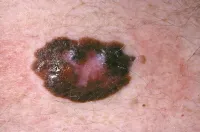 skin cancer 1